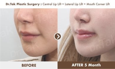 Before and after lip lift results at Dr. Tak Plastic Surgery, enhanced lip contour after 5 months