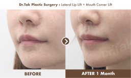 Before and after lip lift and mouth corner lift results at Dr. Tak Plastic Surgery clinic