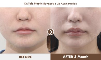 Before and after lip augmentation results at Dr. Tak Plastic Surgery, fuller lips after 3 months