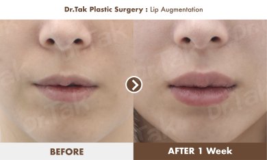 Before and after lip augmentation result at Dr. Tak Plastic Surgery, fuller lips in 1 week