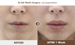 Before and after lip augmentation result at Dr. Tak Plastic Surgery, fuller lips in 1 week