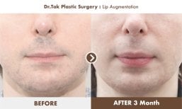 Before and after lip augmentation results at Dr. Tak Plastic Surgery, fuller lips in 3 months