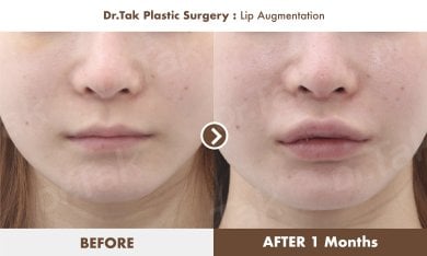 Before and after lip augmentation results at Dr. Tak Plastic Surgery, fuller lips in 1 month