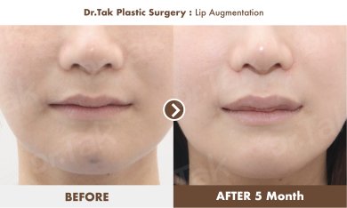 Before and after lip augmentation results at Dr. Tak Plastic Surgery, fuller lips in 5 months