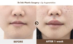 Before and after lip augmentation results at Dr. Tak Plastic Surgery, fuller lips in 1 week