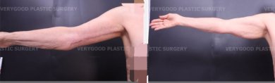 Efekty przed i po plastyce ramion w VG Plastic Surgery – poprawa konturu i napięcia skóry