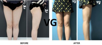 Resultados de liposucción antes y después en VG Plastic Surgery, muslos más delgados y contorno mejorado