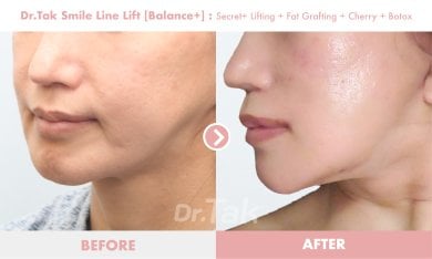 Before and after smile line lift at Dr. Tak Plastic Surgery, visible facial rejuvenation result