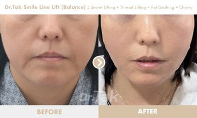 Before and after smile line lift results at Dr. Tak Plastic Surgery, visible facial rejuvenation