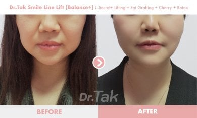 Before and after smile line lift results at Dr. Tak Plastic Surgery, improved nasolabial folds