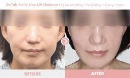 Before and after smile line lift results at Dr. Tak Plastic Surgery, smoother nasolabial folds