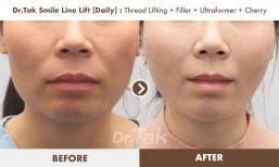 Before and after smile line lift at Dr. Tak Plastic Surgery, visible nasolabial fold reduction result