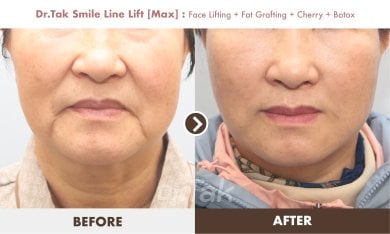 Before and after facelift with fat grafting and Botox at Dr. Tak Plastic Surgery, smile line lift result