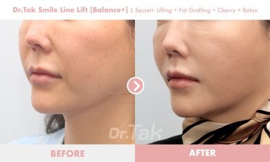 Before and after smile line lift results at Dr. Tak Plastic Surgery, smoother nasolabial folds