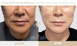 Before and after smile line lift results at Dr. Tak Plastic Surgery, visible facial rejuvenation