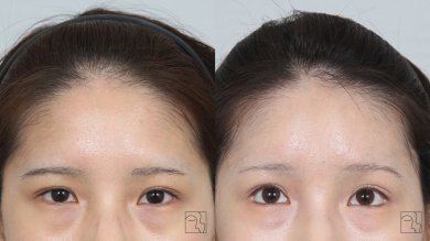 Forehead lift before and after results at Клиника пластической хирургии INIQUÉ, smoother brow