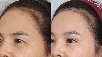 Forehead lift before and after results at Клиника пластической хирургии INIQUÉ, smoother brow