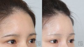 Forehead lift before and after results at Клиника пластической хирургии INIQUÉ, smoother brow