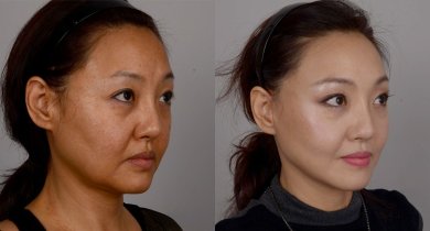 Facelift before and after results at Клиника пластической хирургии INIQUÉ, facial rejuvenation