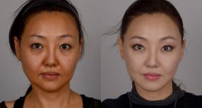 Facelift before and after results at Клиника пластической хирургии INIQUÉ, facial rejuvenation