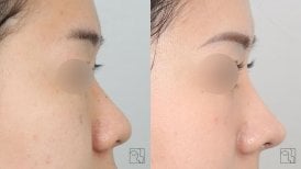 Before and after rhinoplasty results at Клиника пластической хирургии INIQUÉ, nose reshaping