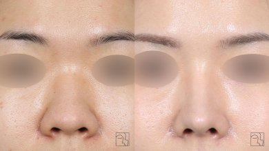 Before and after skin resurfacing at Клиника пластической хирургии INIQUÉ, smoother skin result