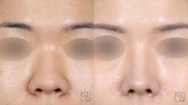 Before and after skin resurfacing at Клиника пластической хирургии INIQUÉ, smoother skin result