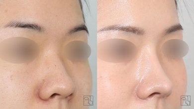 Before and after rhinoplasty results at Клиника пластической хирургии INIQUÉ, nose reshaping
