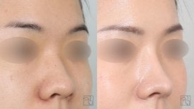 Before and after rhinoplasty results at Клиника пластической хирургии INIQUÉ, nose reshaping