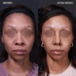Efekty liftingu czoła przed i po w VG Plastic Surgery – widoczne uniesienie brwi