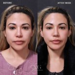 Efekty przed i po liftingu czoła w VG Plastic Surgery, widoczne uniesienie brwi po 1 tygodniu