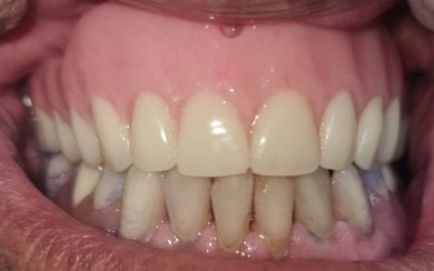 نتيجة تركيب طقم أسنان في SoftDentalCare Clinic – تحسين مظهر ووظيفة الأسنان العلوية