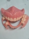 نتيجة تركيب طقم الأسنان في SoftDentalCare Clinic – أطقم أسنان علوية وسفلية