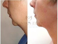 Before and after liposuction results at Klinika Elite Centrum Laseroterapii, chin contouring