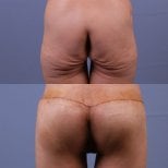 Результаты до и после бразильской подтяжки ягодиц в клинике Dr. Safa Manav, улучшенный контур