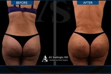 Результаты до и после Brazilian Butt Lift в клинике Dr. Safa Manav, улучшенный контур ягодиц