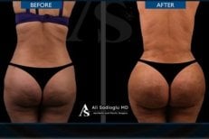 Результаты до и после Brazilian Butt Lift в клинике Dr. Safa Manav, улучшенный контур ягодиц