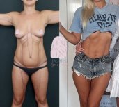 Результаты до и после абдоминального этчинга (кубики пресса) в клинике Dr. MED