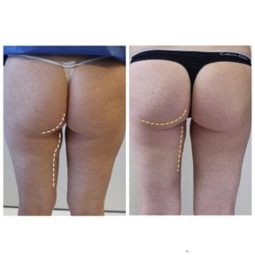 Before and after liposuction results at Klinika La Perla, improved thigh and buttock contour