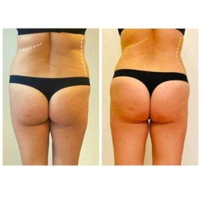 Before and after liposuction results at Klinika La Perla, improved waist and body contour