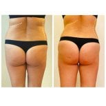 Before and after liposuction results at Klinika La Perla, improved waist and body contour