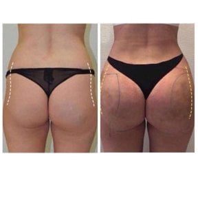 Before and after butt implants at Klinika La Perla – enhanced shape and volume results