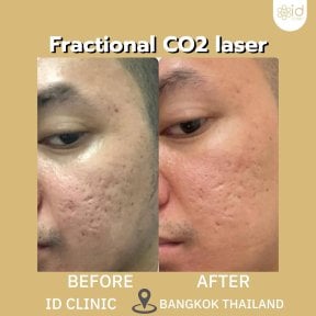 before-after photo threads-lifting