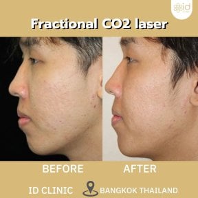 before-after photo threads-lifting