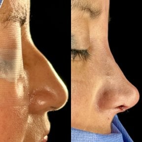 نتائج عملية تجميل الأنف قبل وبعد، إعادة تشكيل الأنف وتحسين المظهر الجانبي