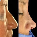 نتائج عملية تجميل الأنف قبل وبعد، إعادة تشكيل الأنف وتحسين المظهر الجانبي