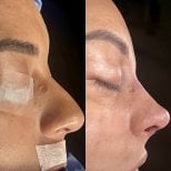 Before and after rhinoplasty results, nose reshaping and profile improvement at clinic