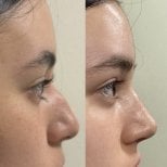 نتائج عملية تجميل الأنف قبل وبعد، إعادة تشكيل الأنف وتحسين المظهر الجانبي