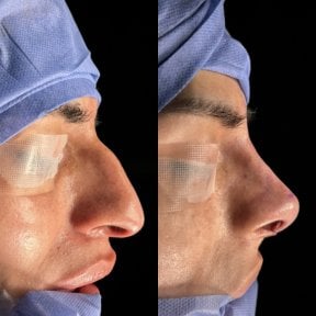 نتائج عملية تجميل الأنف قبل وبعد، تحسين شكل الأنف والملف الجانبي في العيادة