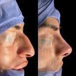 نتائج عملية تجميل الأنف قبل وبعد، تحسين شكل الأنف والملف الجانبي في العيادة